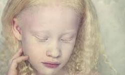 Tek bir nedeni bulunmayan Albinizm hastalığı nedir? Tedavisi var mıdır?