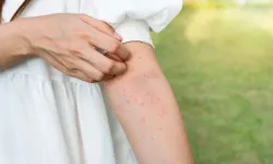 Sivrisineklerden kaçamayanlar için: Bunu yaparak Sivrisinek ısırıklarını iyileştirin!