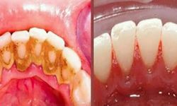 Diş tartarlarını temizlemenin en kolay yolu! Bu malzemeler varsa hemen deneyin