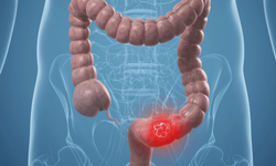 Kolon kanseri: Dünya genelinde yaygın ve tehditkar bir hastalık