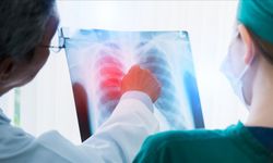 Akciğer kanserinde çevresel tehdit büyüyor: Büyükşehirlerde risk yüzde 40’a kadar artıyor