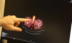 Dünya'da sadece 60 tane olan vaka Türkiye'de görüldü... Kanser penis kaybına neden oldu!