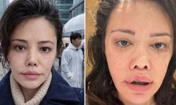 Didem Ceran'ın yüzüne ne oldu, yandı mı?