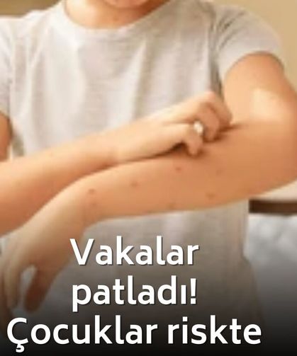 Aşı karşıtlığı Suçiçeği vakalarını artırdı! Uzmandan korkutan uyarı