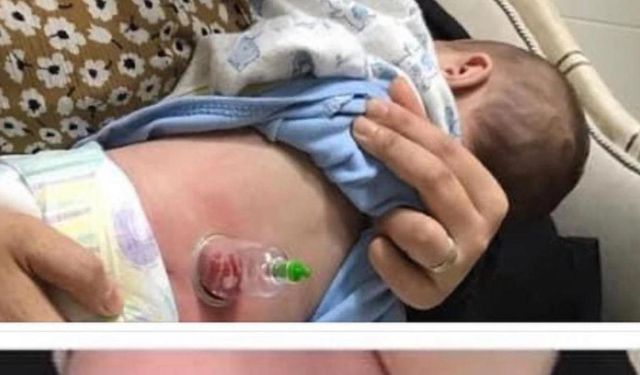Başakşehir'de hacamat skandalı: Bebeklere yapılan uygulama için soruşturma açıldı