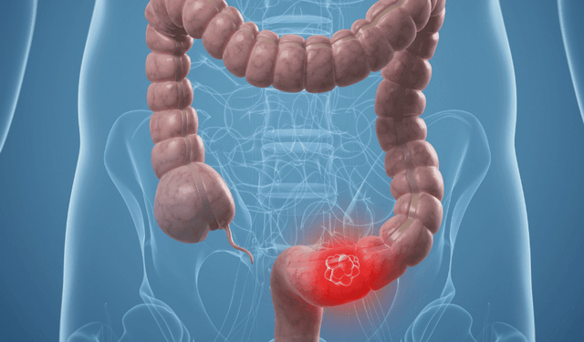 Kolon kanseri: Dünya genelinde yaygın ve tehditkar bir hastalık