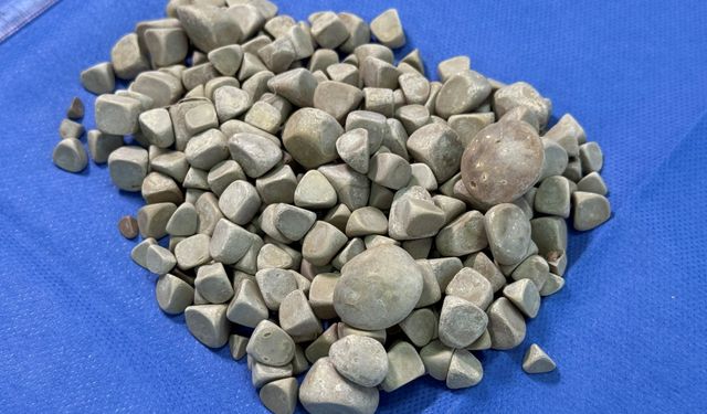 Vücudundan 287 taş çıktı: Doktorlar bile şaşırdı!