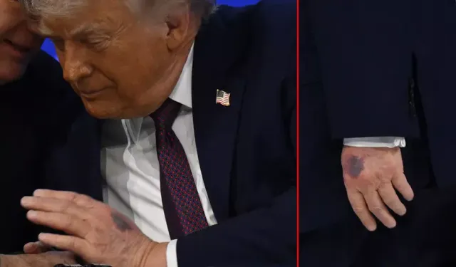 Herkes bunu merak ediyordu! Trump’ın elindeki morluğun nedeni ortaya çıktı