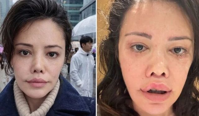 Didem Ceran'ın yüzüne ne oldu, yandı mı?