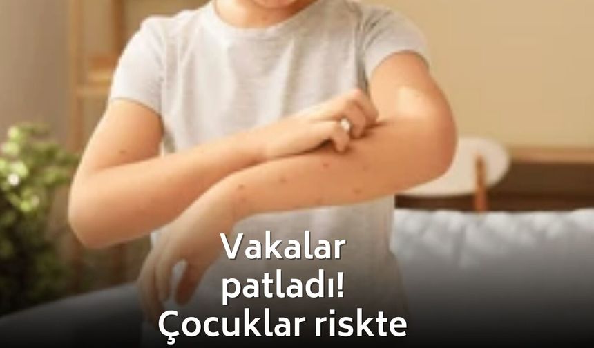Aşı karşıtlığı Suçiçeği vakalarını artırdı! Uzmandan korkutan uyarı