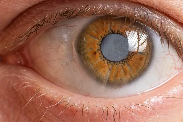 Göz içi basıncın artmasına bağlı gelişiyor