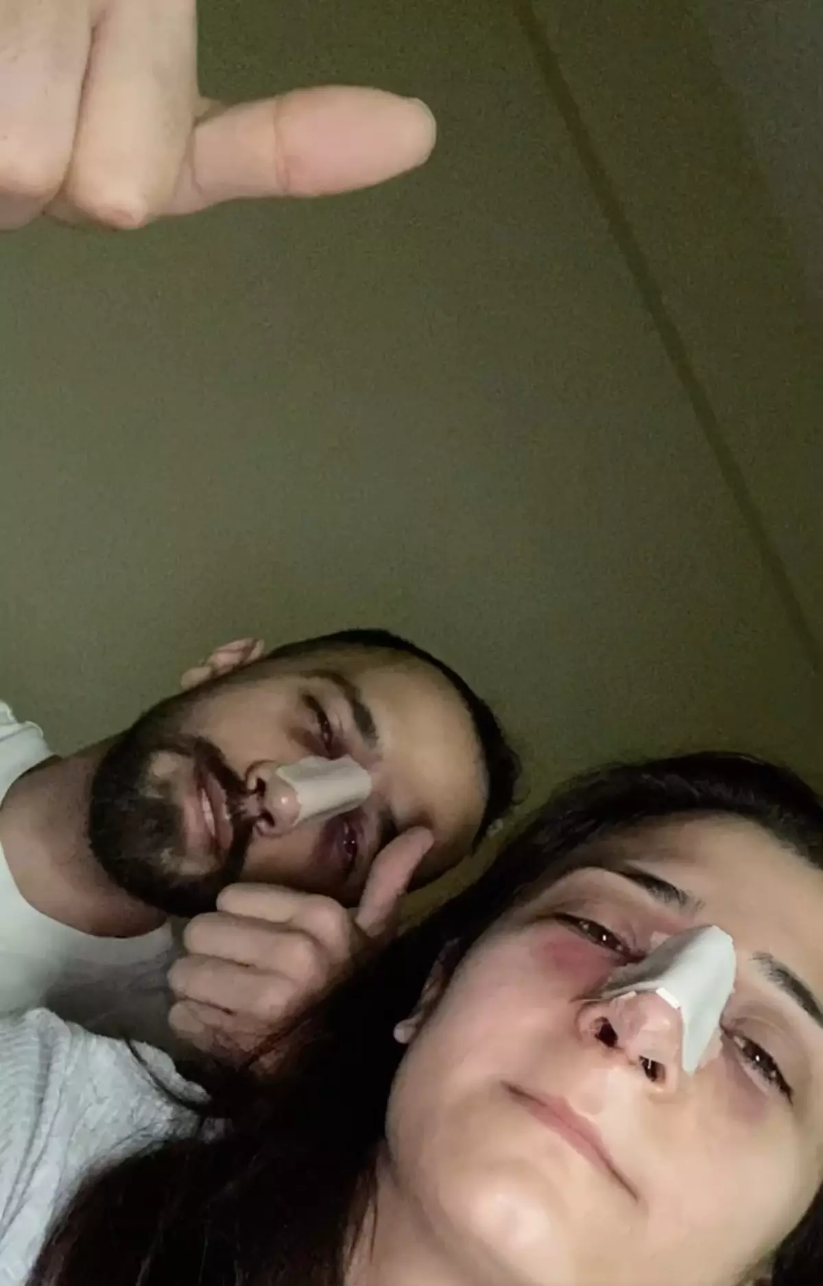 Çift Nişan Takılarını Bozdurarak Burun Estetiği Yaptırdı