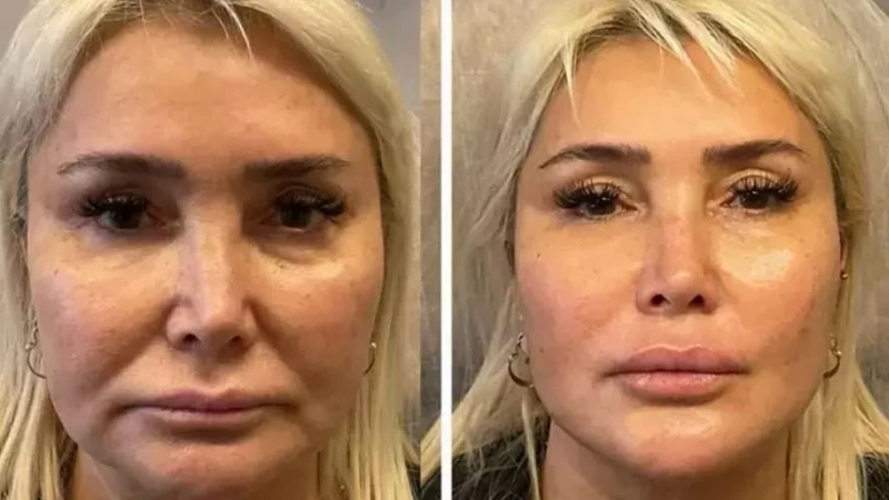 Estetik ameliyatlarını gizlemiyor