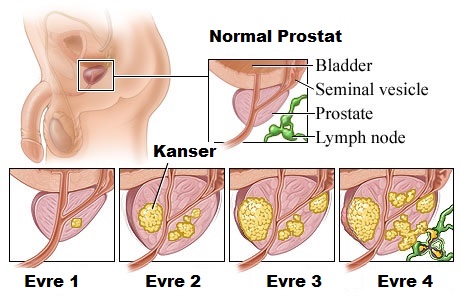 Prostat kanserinin belirtileri nelerdir, tanı nasıl konur?