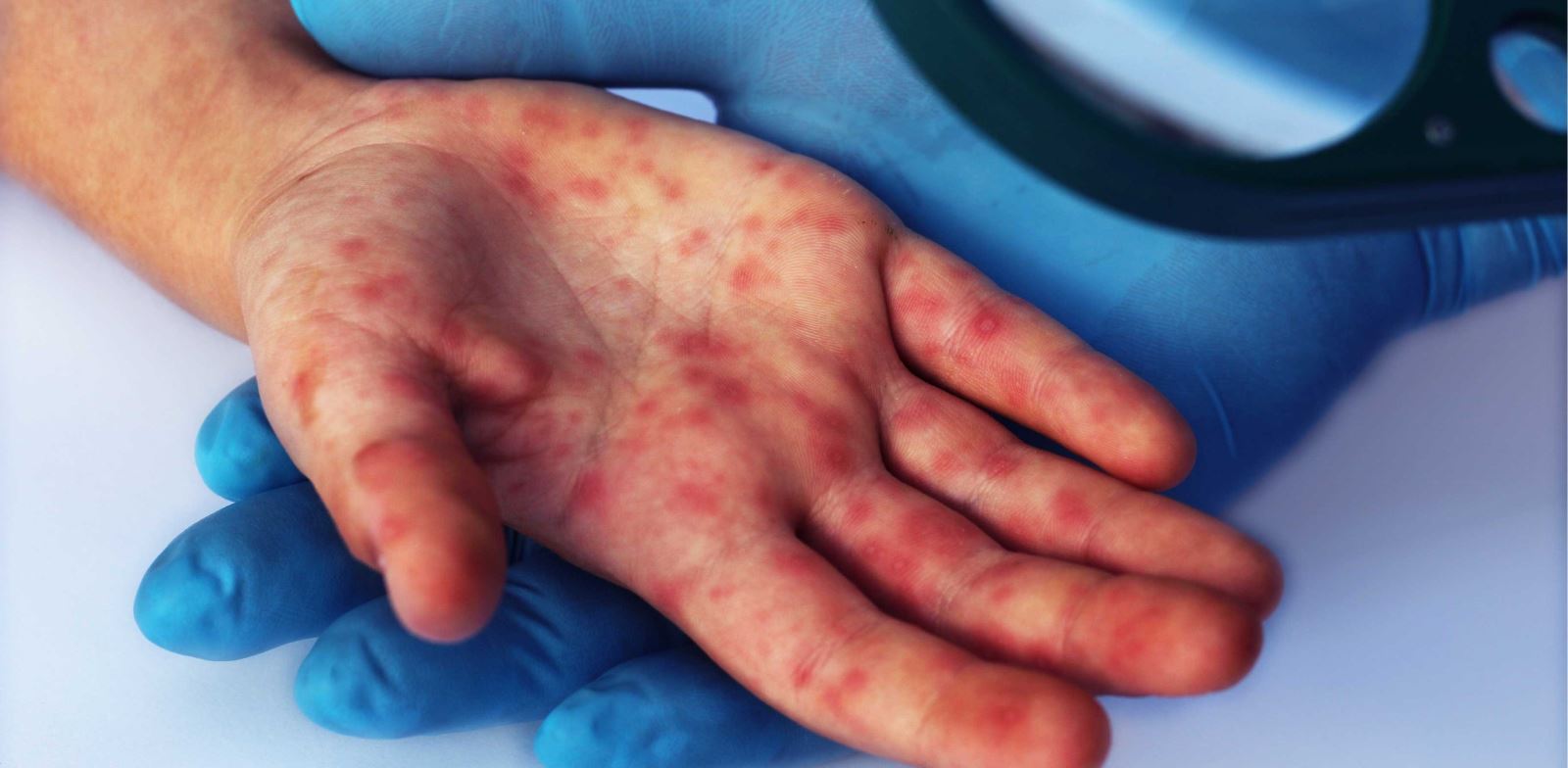 El Ayak Hastalığının Bulaşmaması İçin Alınması Gereken Önlemler Nelerdir?