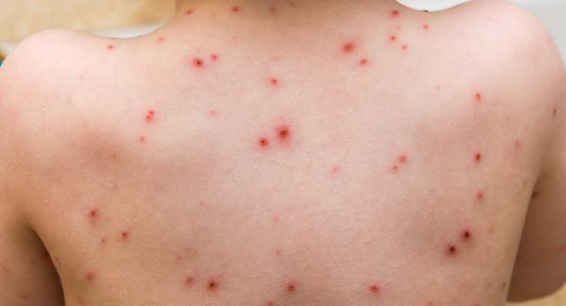 Su Çiçeği Hastalığına Ne İyi Gelir?