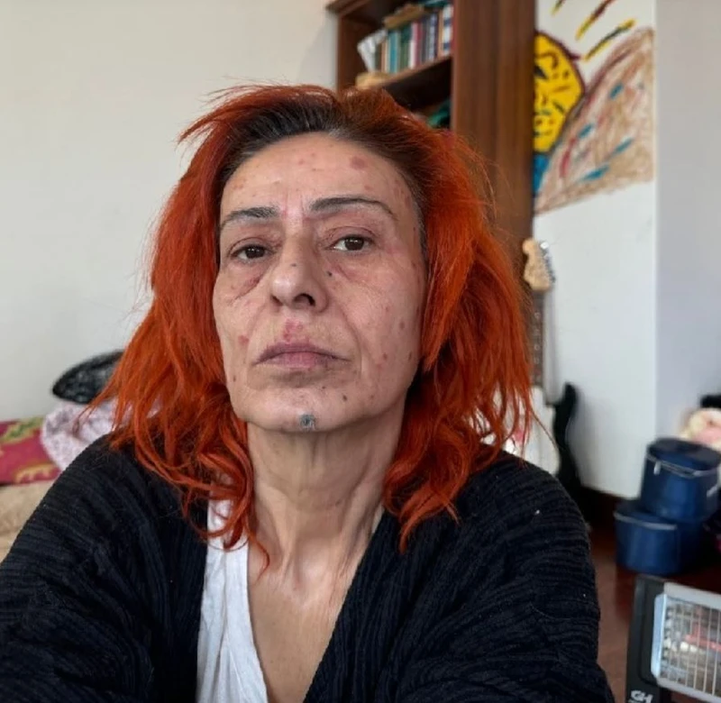 Yıldız Tilbe Yüzü Yandı 1