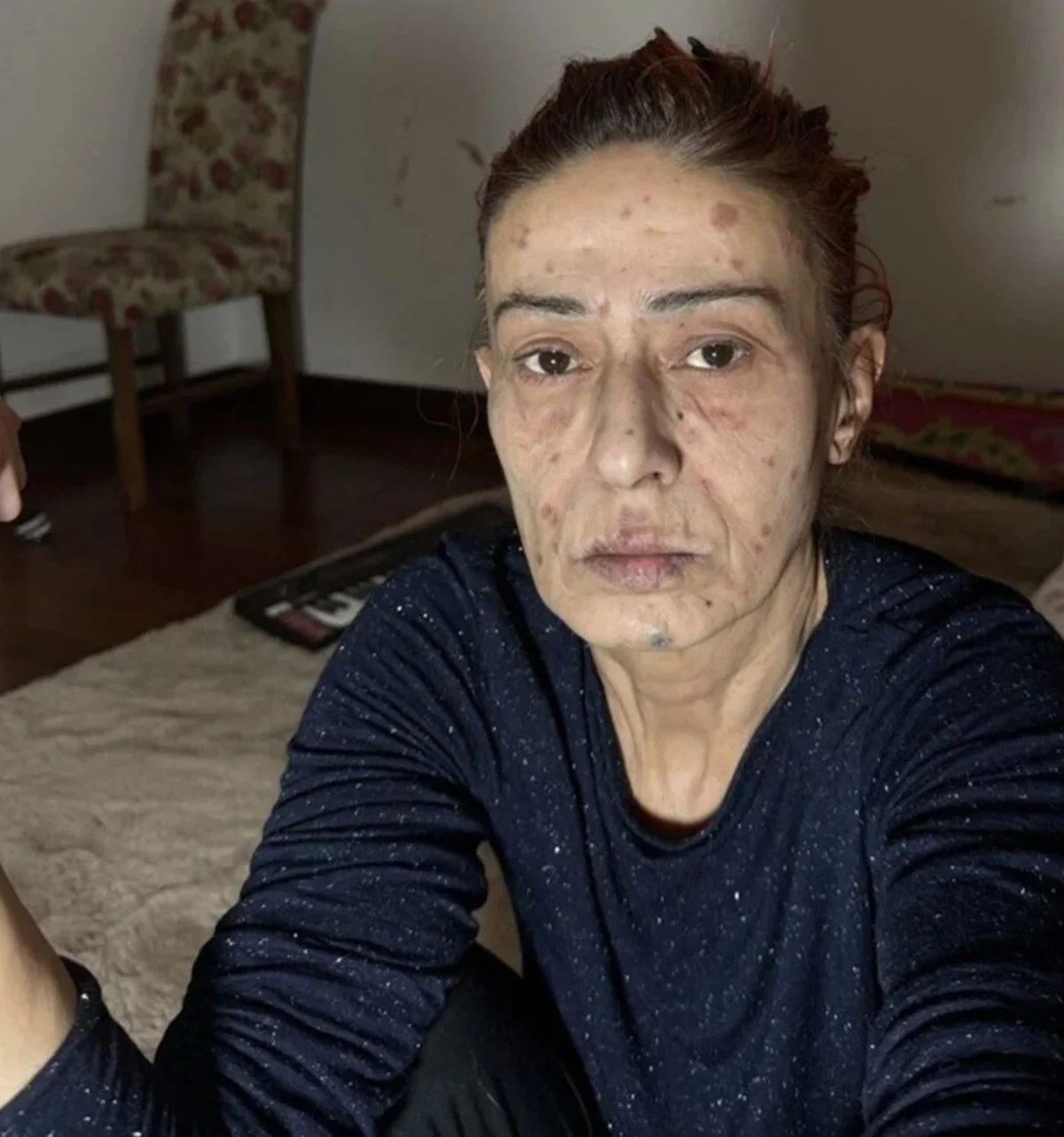 "Kimyasal yanık oldum"