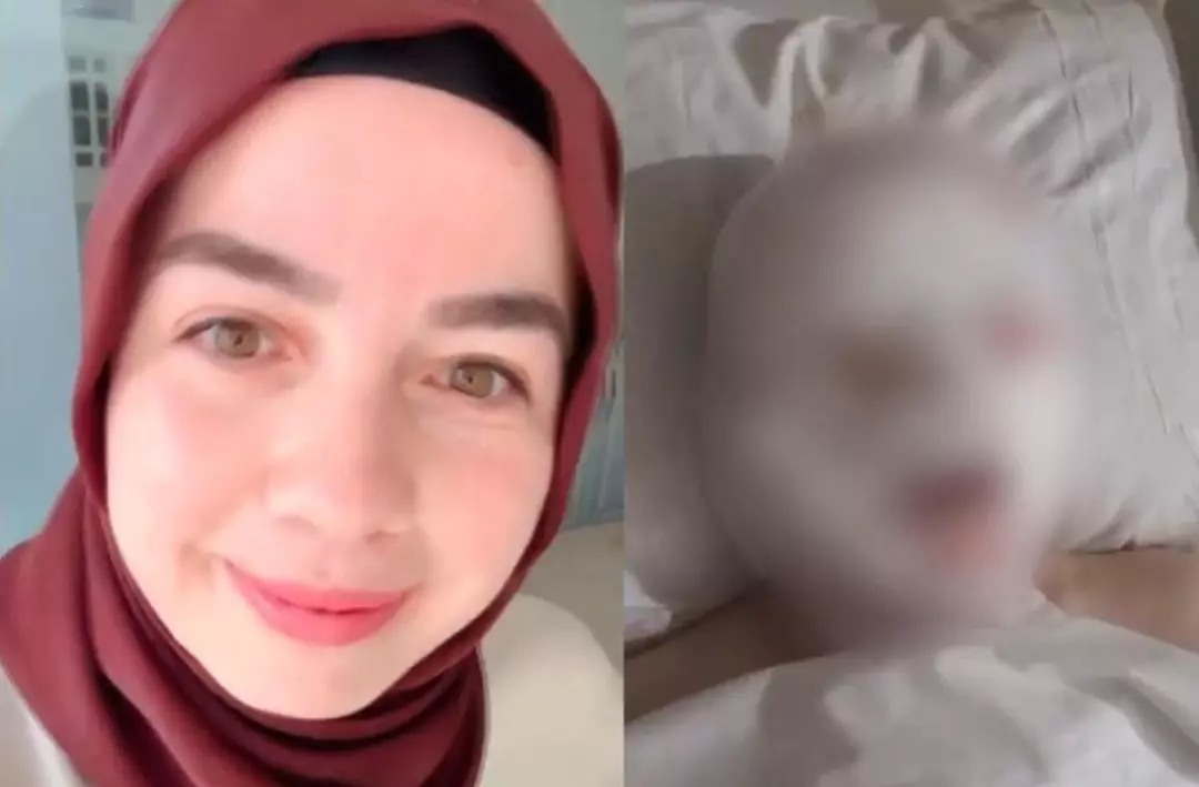 Yapılan muayenelerde kadının iki gözünü birden kaybettiği ve vücudunda ciddi yanıklar olduğu belirlendi.