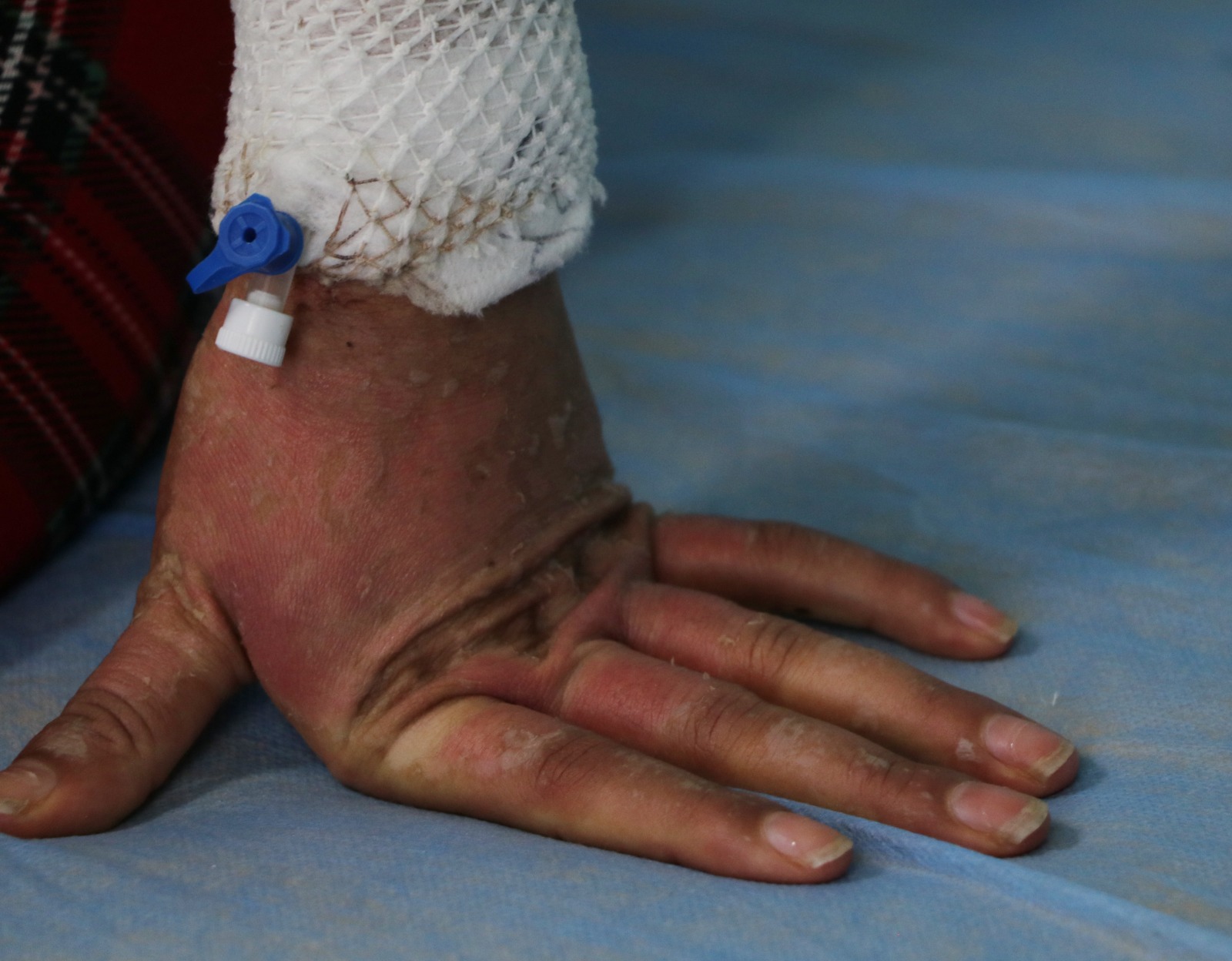 Krem kullanımı sonrası yoğun bakımlık oldu