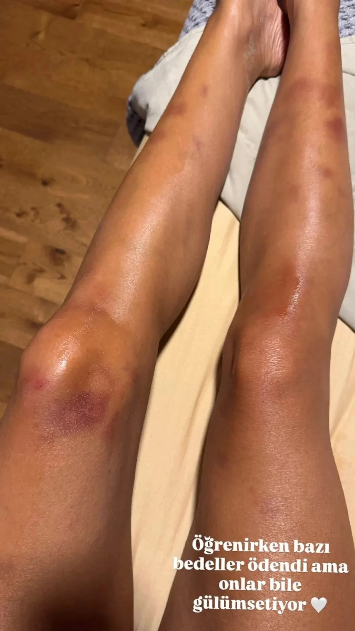 Çağla Şıkel Morarmış Bacakları