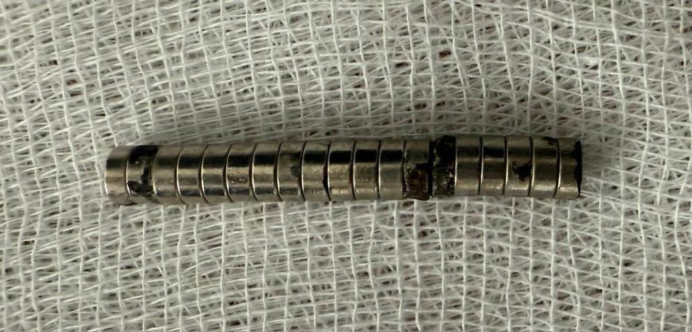 Çocuğun Boğazındaki Mıknatıslar 2