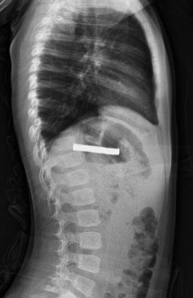 Çocuğun Boğazındaki Mıknatıslar