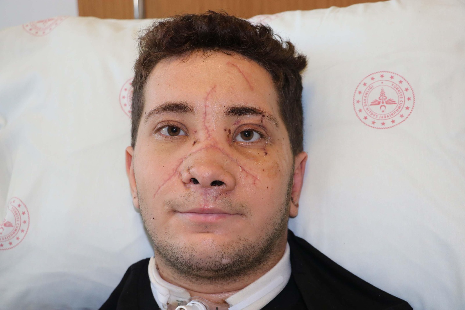 Mikro cerrahi ile burun dokusu kurtarıldı