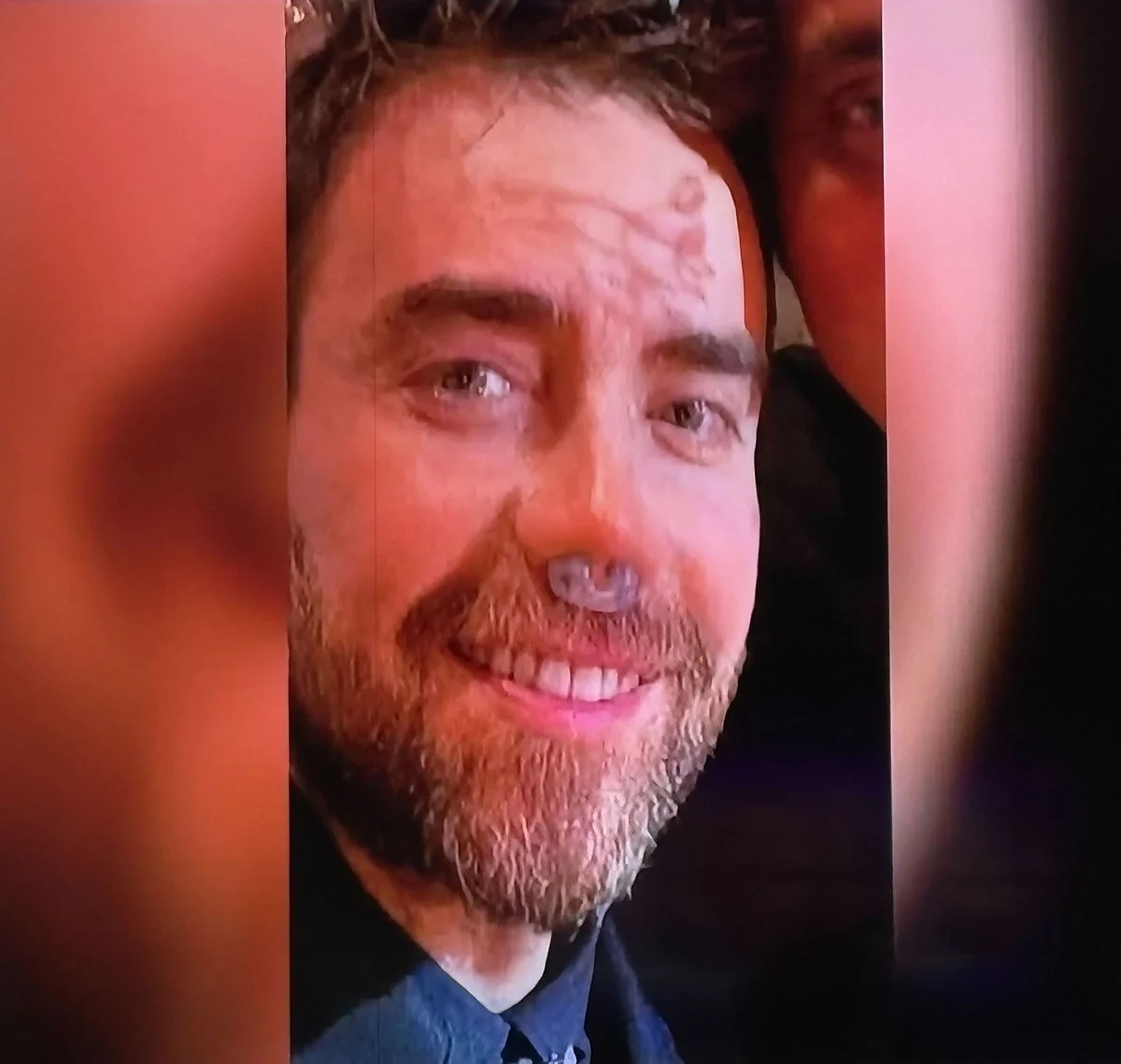 Murat Dalkılıç 12. Kez Burun Ameliyatı Oldu!