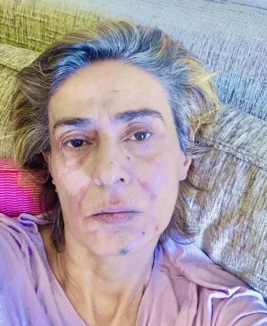 Yıldız Tilbe Yüzünün Son Hali